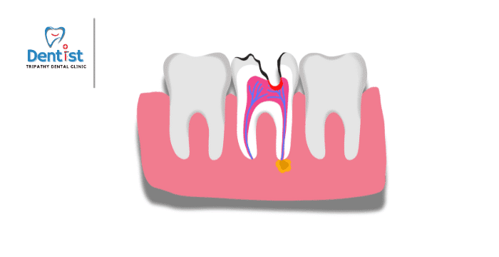 “how much does root canal treatment cost? A guide for patients seeking affordable care”