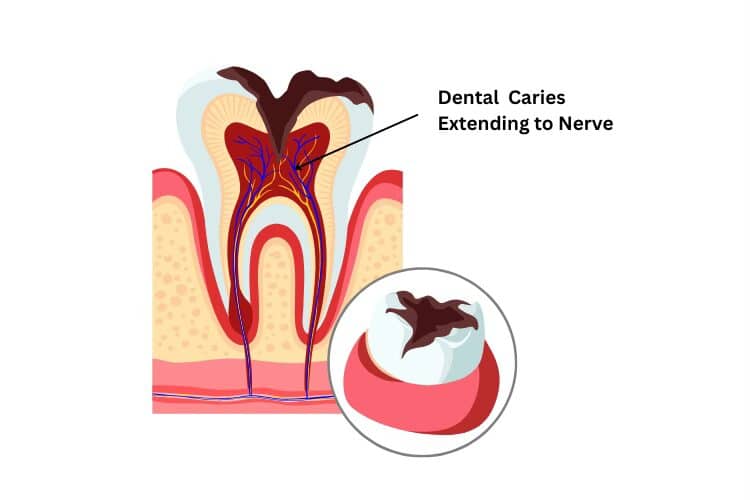 “best root canal treatment in noida”: painless and affordable