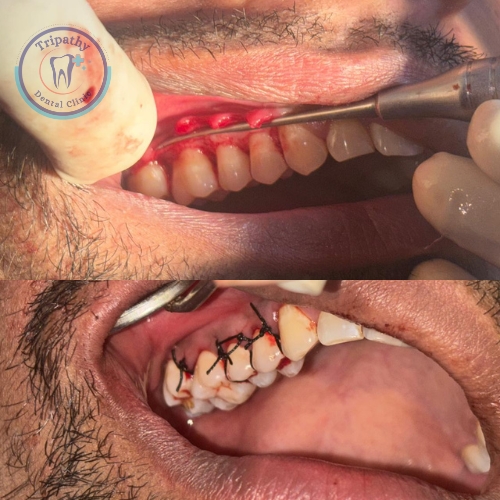 Gum Flap Surgery