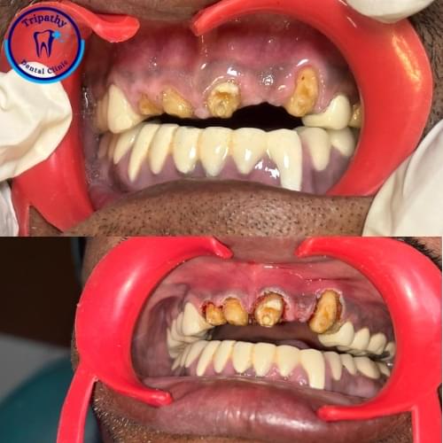 Cwown Legthenening Procedure