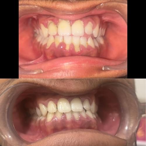 Scaling and Root Planing (SRP)