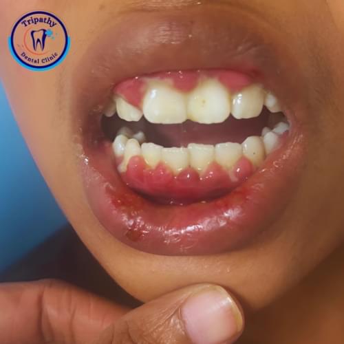 Gingivectomy/Gingivoplasty