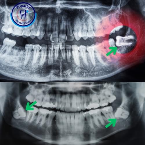 Wisdom Tooth Extraction